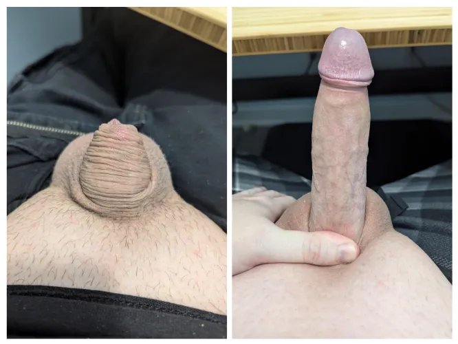 Thumbnail Witness the Growth: A Foreskin Transformation