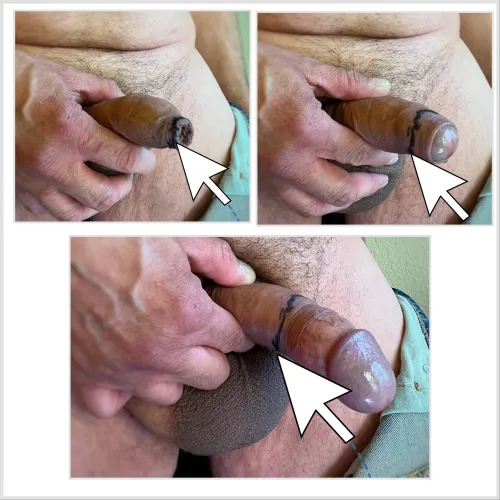 Thumbnail Understanding Foreskin Movement: Black Line Indicates Tip Motion | PlasticApartment9491