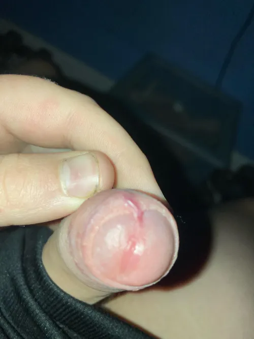 Thumbnail Understanding Foreskin Retraction Challenges with Inevitable_Jaguar_76