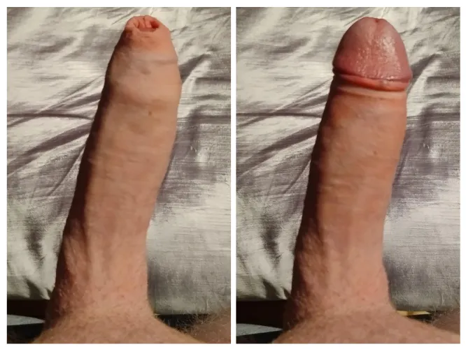 Thumbnail Embracing My Tight Foreskin: A Personal Journey